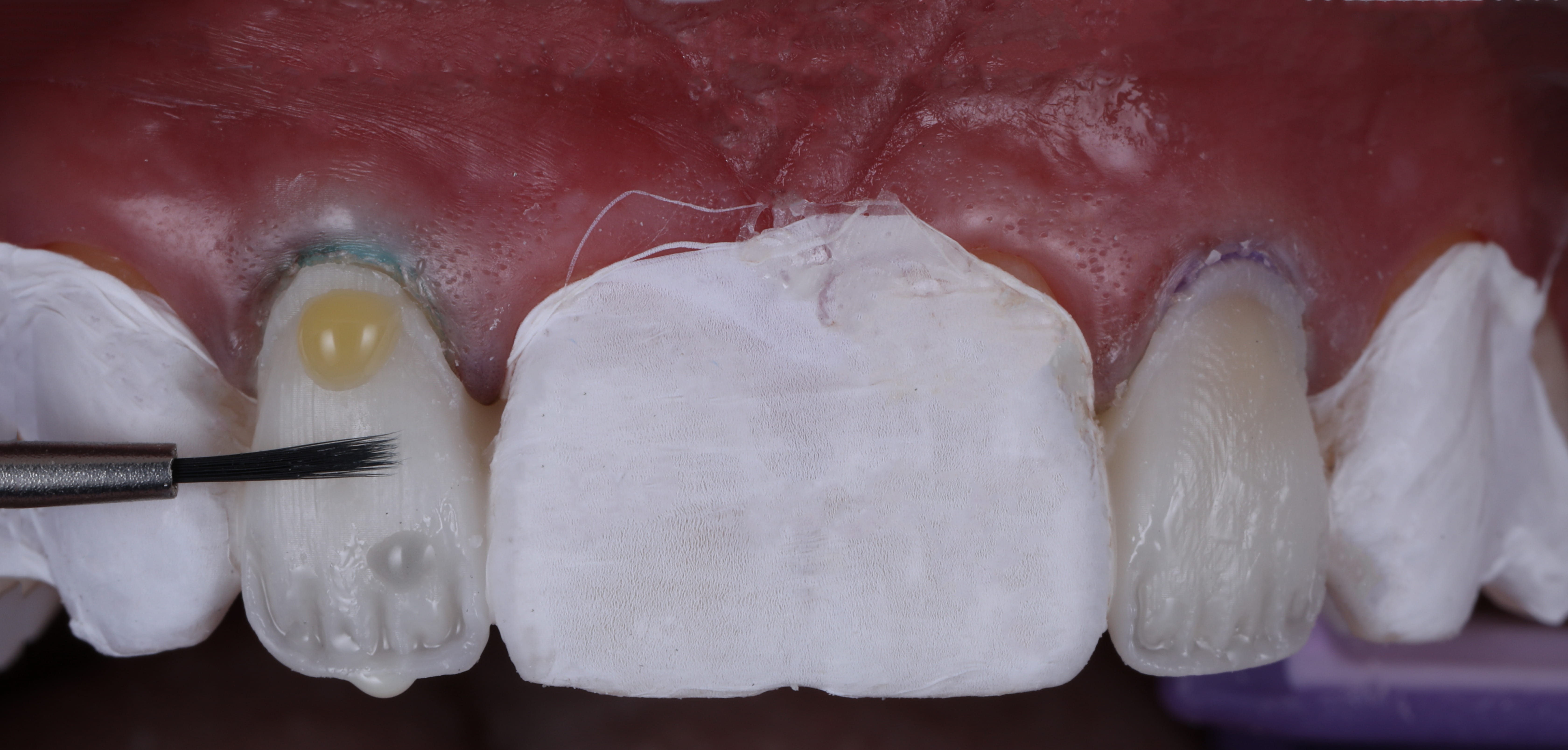AACD Journal of Cosmetic Dentistry Digital Anatomic Stratification: Combining Art, Predictability, and Efficiency
